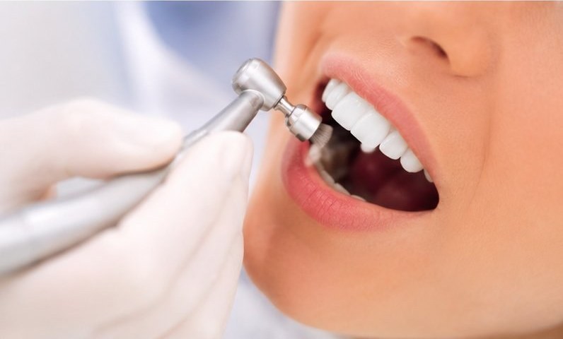Professionelle Zahnreinigung Berlin – FamDental